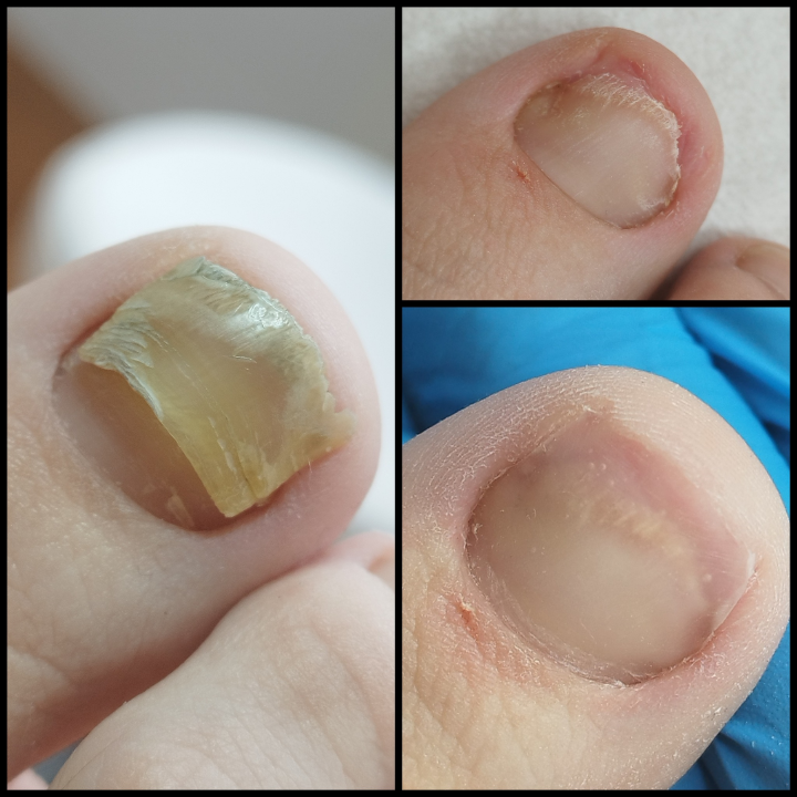 Riješite se uraslih noktiju uz medicinsku pedikuru!