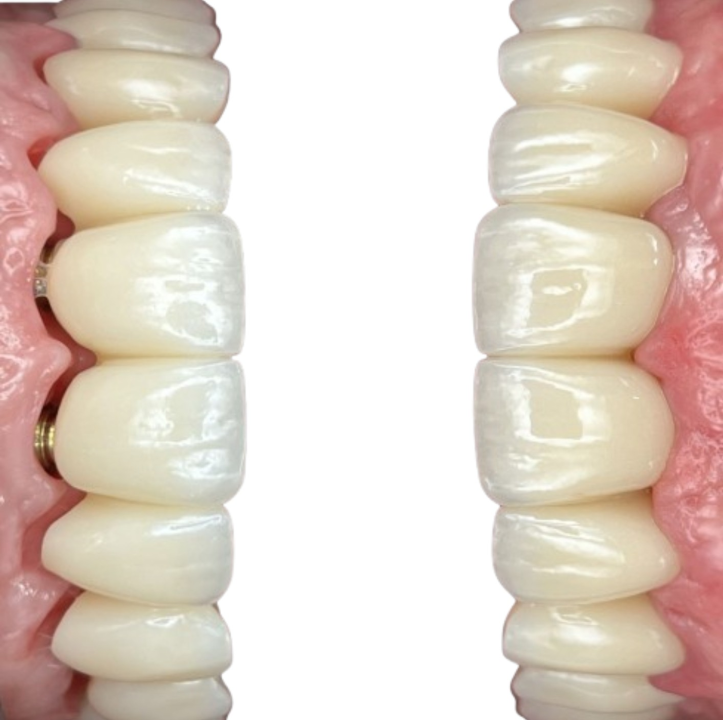 FOTO Životna prekretnica uz Dental centar Dubravica: Što trebate znati prije ugradnje implantata