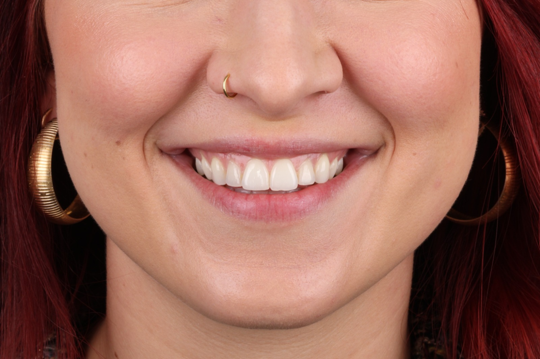 FOTO Osmijeh iz snova uz prozirne alignere Dental centra Dubravica! 	