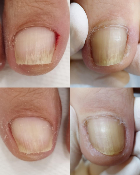 Pružite svojim stopalima maksimalnu njegu i riješite tegobe uz medicinsku pedikuru!