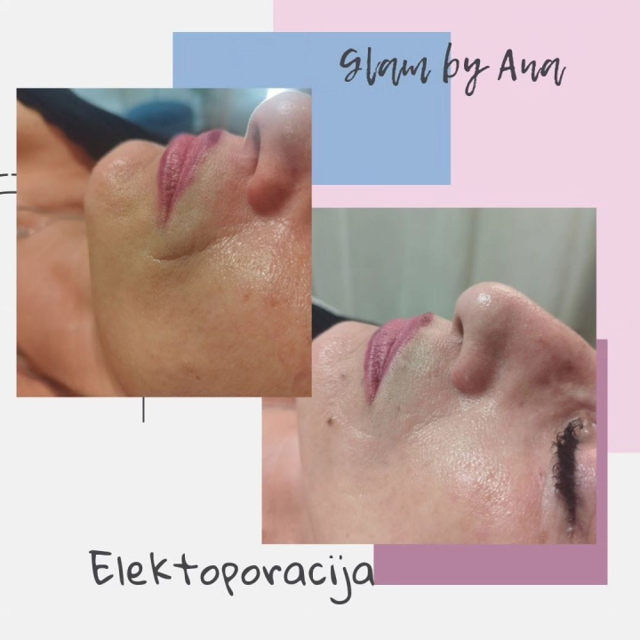 Uz Glam by Ana uklonite trajnu šminku i tetovaže bez boli!