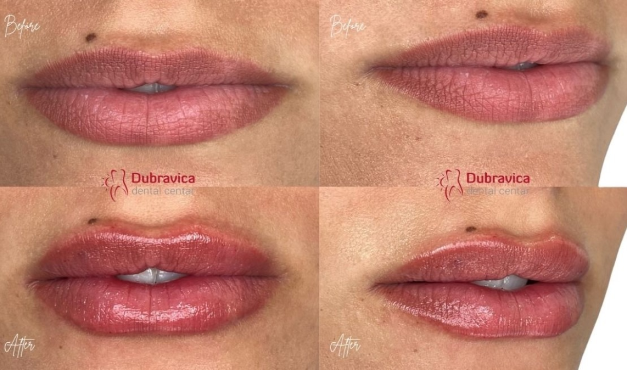 FOTO Dan žena u Dubravici: Iskoristite popust na najnovije trendove u estetskoj medicini 