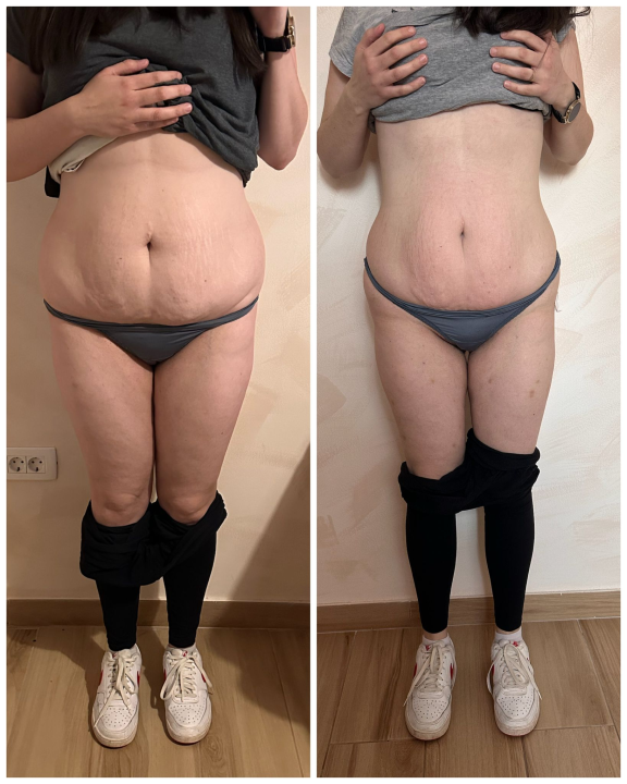 FOTO Beauty Clinic by Tamara: Smanjite celulit i ovo ljeto prošetajte plažom samouvjereno!