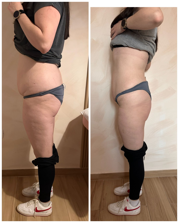 FOTO Beauty Clinic by Tamara: Smanjite celulit i ovo ljeto prošetajte plažom samouvjereno!