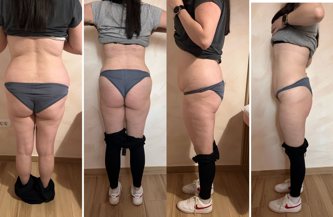 FOTO Beauty Clinic by Tamara: Smanjite celulit i ovo ljeto prošetajte plažom samouvjereno!