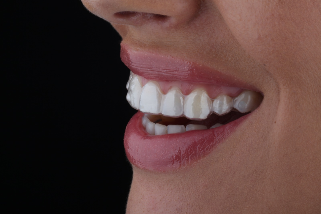 FOTO Osmijeh iz snova uz prozirne alignere Dental centra Dubravica! 	