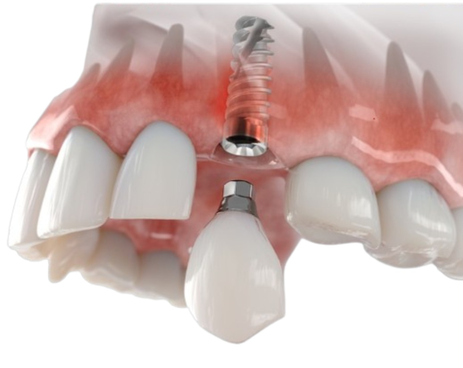 FOTO Novi osmijeh uz Dental centar Dubravica: Što trebate znati prije ugradnje implantata